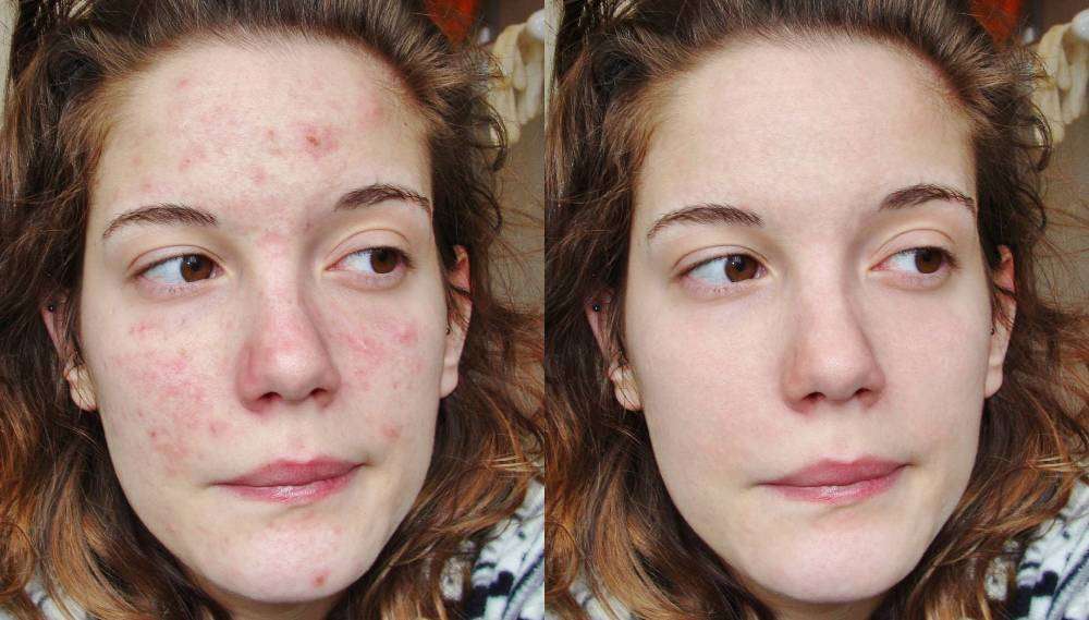 cliomakeup-dermatillomania-trattamenti-cure-cicatrici-17.jpg